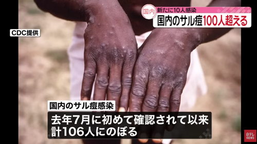 警惕！日本猴痘感染者突然增加，已经超100人！