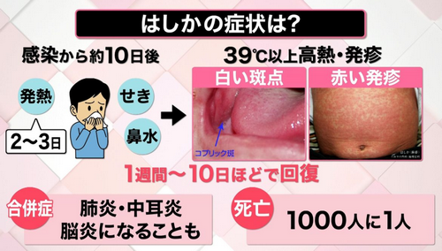 警惕！日本接连出现麻疹感染者，厚生劳动生紧急提醒尽快接种疫苗